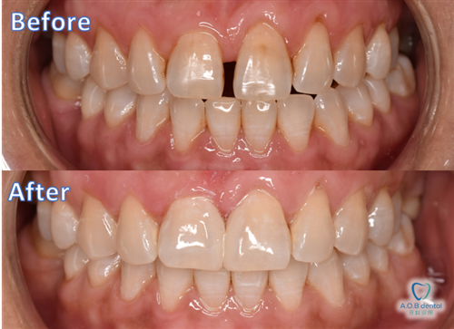 Teeth Restoration