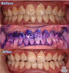 Scaling + Airflow (Oral Spa)